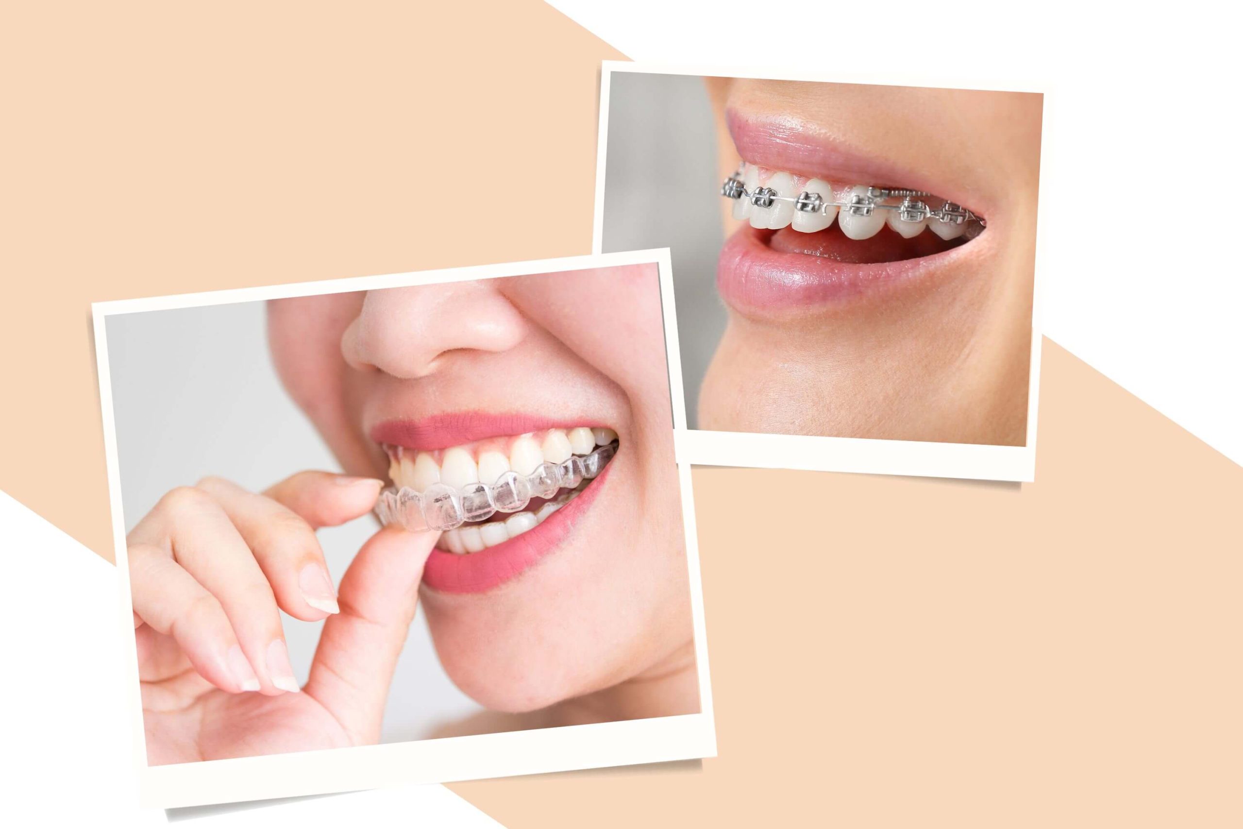 láthatatlan vagy fix fogszabályozó